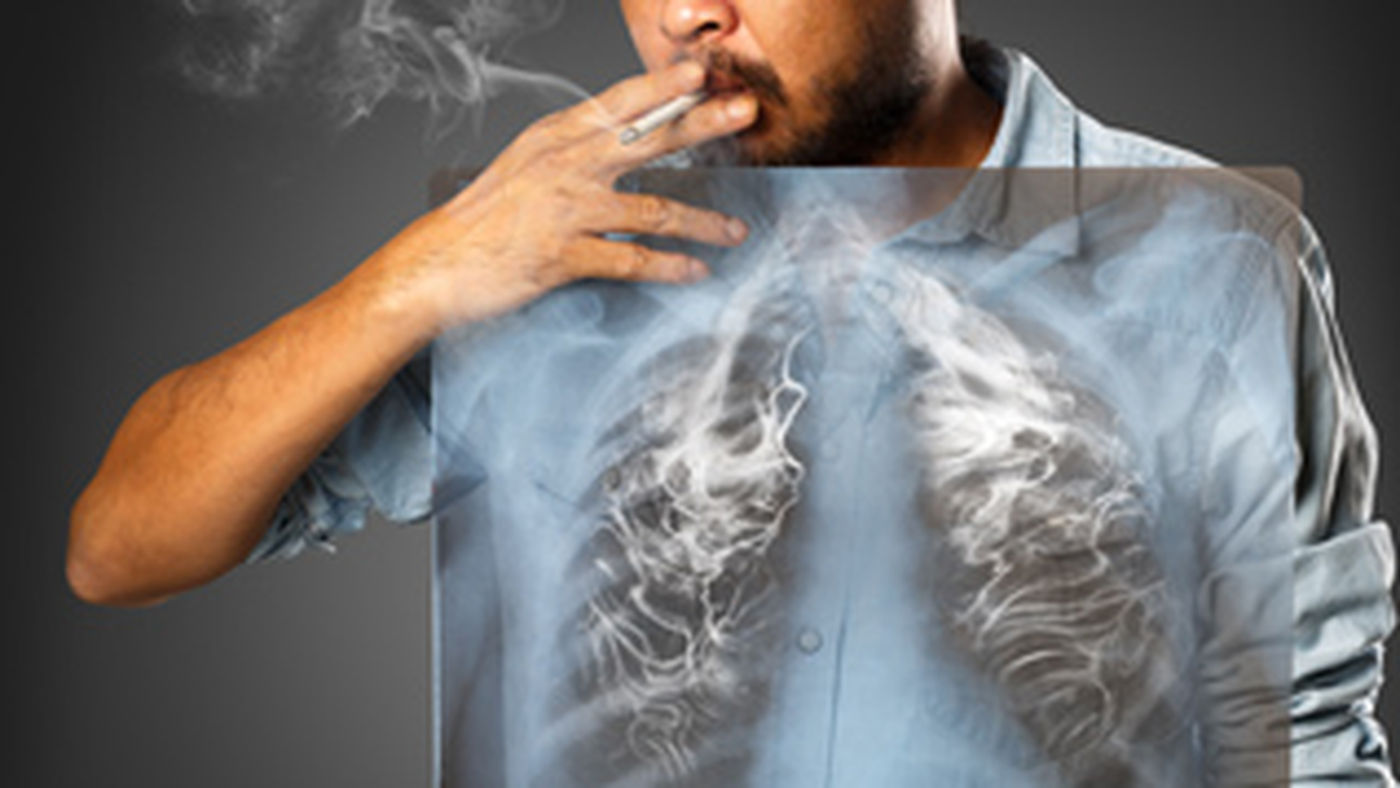 Cancer du poumon et dépistage chez les fumeurs : l'avis de l'HAS